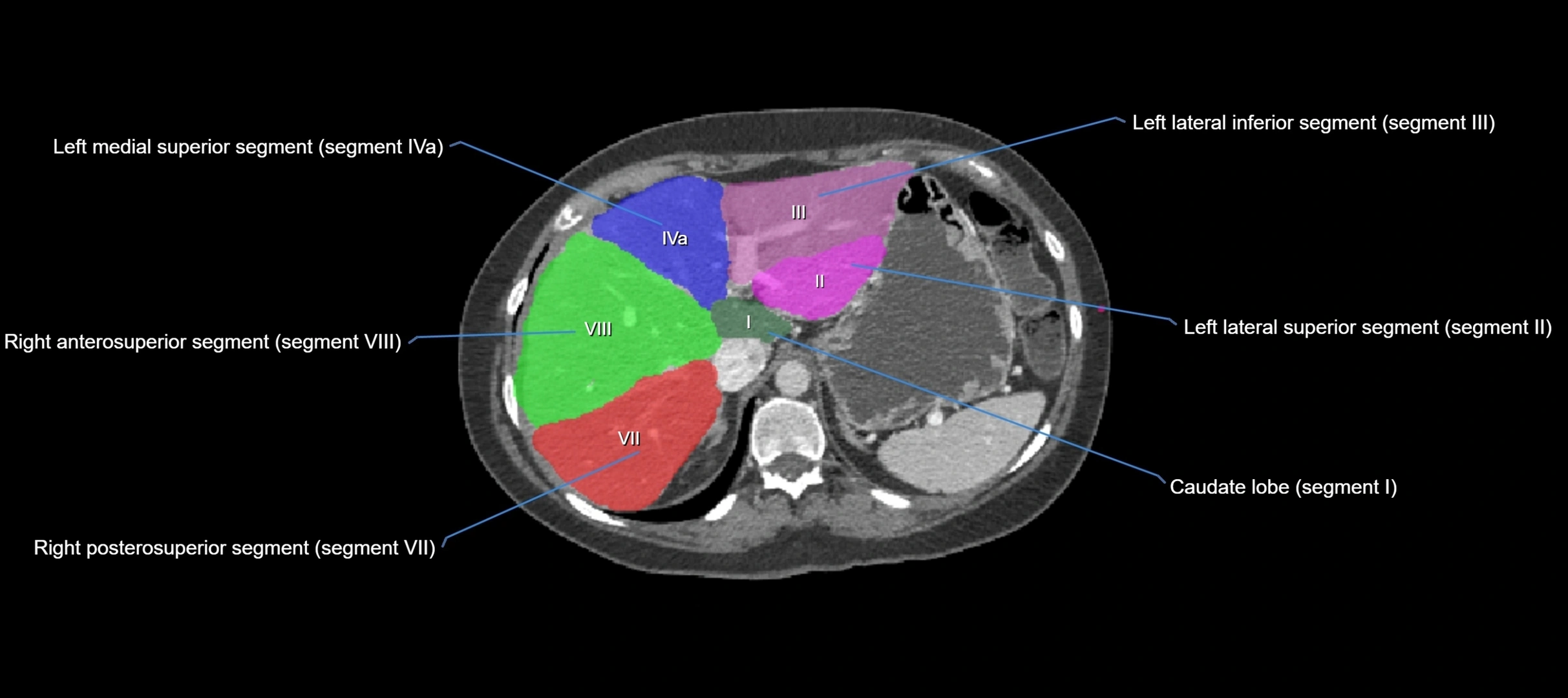 CT liver segments axial cross sectional anatomy labelled image-00054.webp